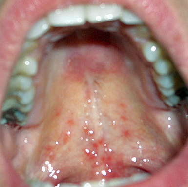 Red Spots On Soft Palate Of Mouth 85